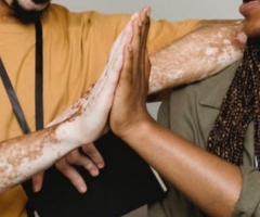Vitiligo Treatment in India: Say Bye-Bye to Skin Diseases - 1