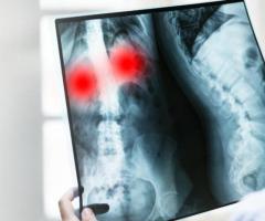 Where to Get Spinal Tuberculosis Treatment in India?