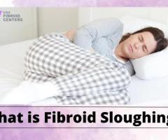 What is Fibroid Sloughing? - 1
