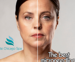 The best microneedling Chicago