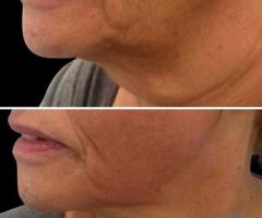 Ultimate Skin Tightening Services in Vaughan