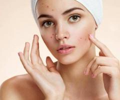 Best acne scar treatment in chennai