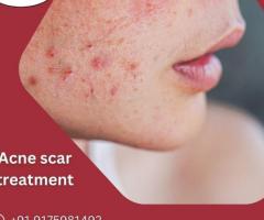 Skin Renewal Unleashed: Specialized Acne Scar Therapy