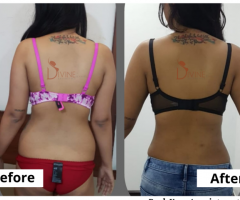 BEST LIPOSUCTION RESULTS AT DIVINE COSMETIC SURGERY