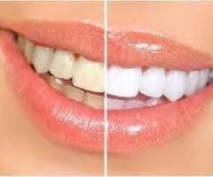 Chemical-Free Teeth Whitening: Natural Alternatives that Work