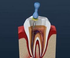 Root Canal Treatment in Noida - 1