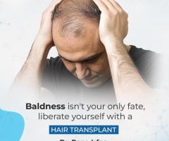 Hair Transplant Service by Dr Rana Irfan in Islamabad - 1