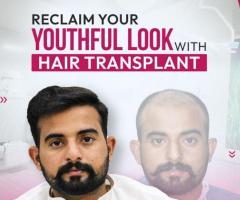 Hair Transplant Service by Dr Rana Irfan in Islamabad, Pakistan - 1