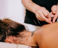 Cupping Therapy, Acupuncture Therapy Burlingame, CA - 1