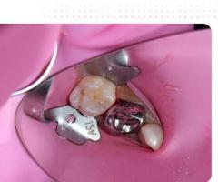 Best Root Canals Treatment for Children in Pune |Root Canals for Children in Shivaji Nagar