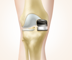 Best partial knee replacement treatment doctor in Indore - Dr. Vinay Tantuway