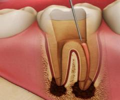 Root Canal Treatment In Pune |Root Canal Treatment in Shivaji Nagar