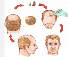 hair transplantation in  prayagraj , uttar pradesh